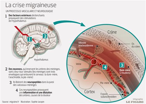 Migraine Que Se Passe T Il Fiches Santé Et Conseils Médicaux