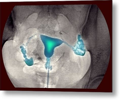 Female Reproductive Organs X Ray Photograph By Du Cane Medical Imaging Ltd