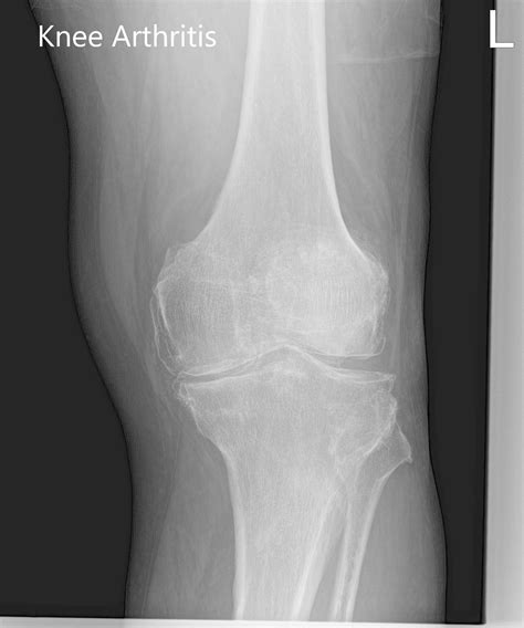 Knee Xray Displays Basic Knee Joint Anatomy Including