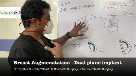 Illustration Dual Plane Breast Augmentation YouTube