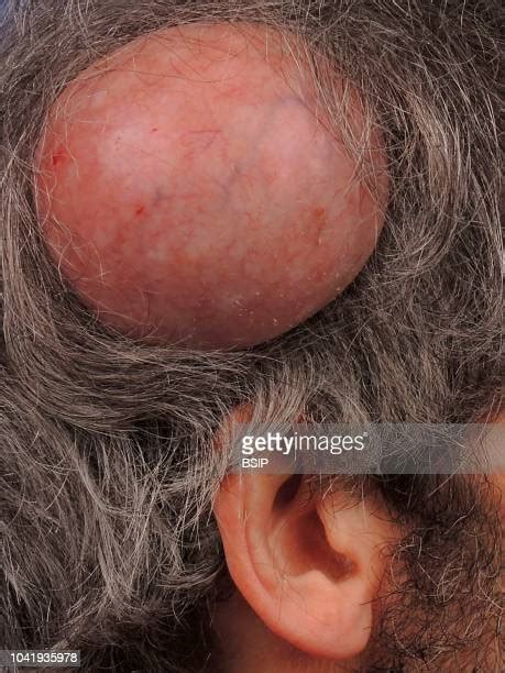 Sebaceous Cyst Fotografías E Imágenes De Stock Getty Images