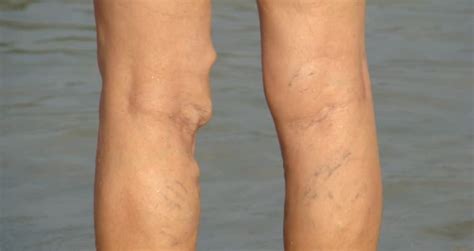 Why Do Some Varicose Veins Bulge Stick Out Vein Solutions