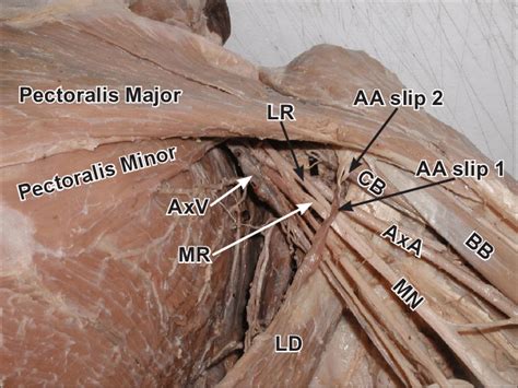 Dissection Of The Left Axilla Where The Axillary Pad Of Fat And