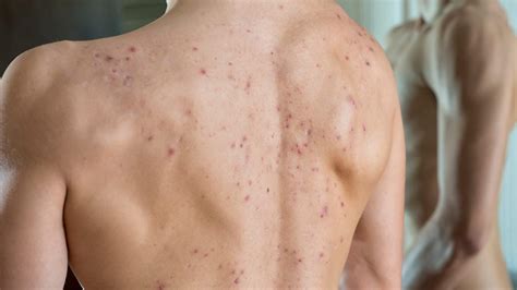 Cystic Back Acne Causes And How To Treat It