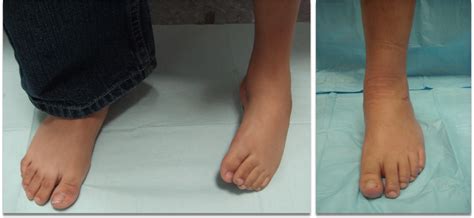Clubfoot Surgery Adult And Pediatric Ilizarov FOOT ANKLE SURGERY