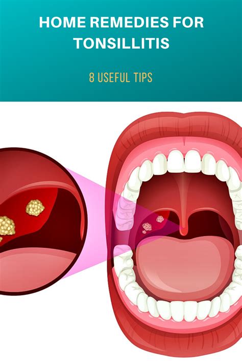 Inflammation Of The Tonsils Is One Of The Diseases That Make Everyday