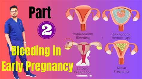 Bleeding In Early Pregnancy Part 2 Implantation Bleedmiscarriage
