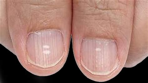 Do You Have These Vertical Ridges On Your Nails Youtube