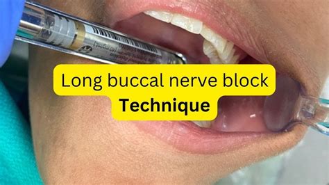 How To Give Long Buccal Nerve Block Youtube