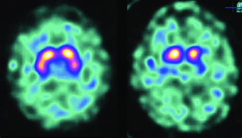 Normal And Abnormal Dat Spect Scans The Image On The Left Shows Normal