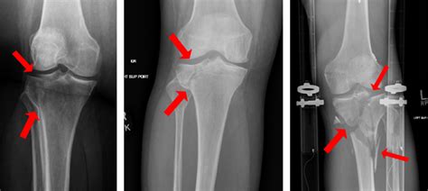 Anterior Tibial Plateau Fracture