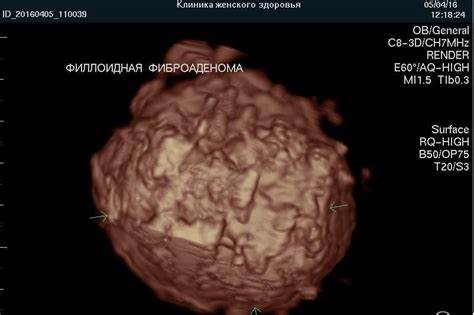 Фиброаденома молочной железы диета Фиброаденома молочной железы с нечеткими контурами Фиброаденома молочной железы с нечеткими контурами Фиброаденома молочной железы диета