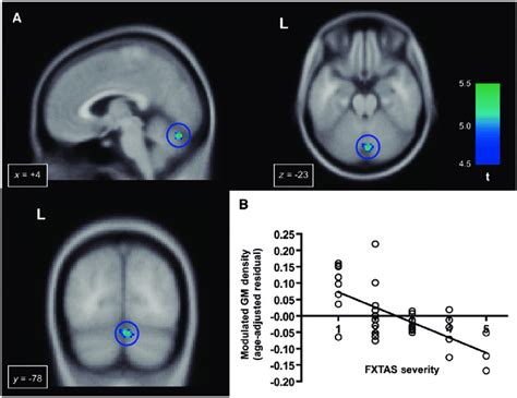 Progressive Grey Matter Gm Loss Correlated With The Severity Of