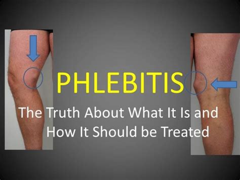 Phlebitis Causes Symptoms Treatment And Surgery