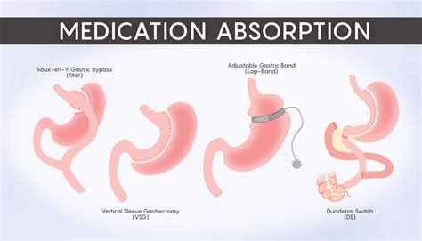 Understanding The Impact Of Medication Absorption After Wls Obesityhelp