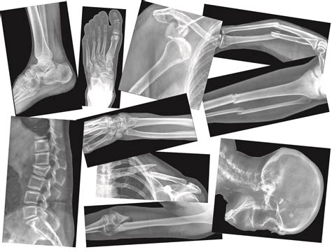 X Rays Of Broken Bones Anderson Scientific