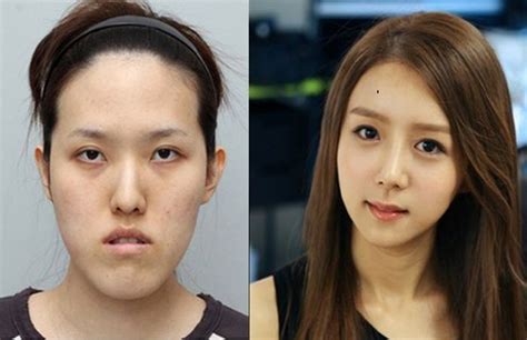 Antes E Depois Da Cirurgia Pl Stica Coreana Fotos Mdig