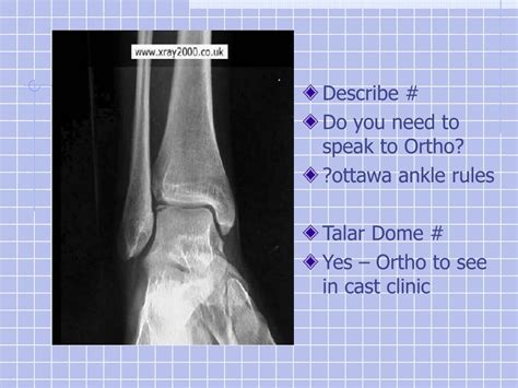 Ppt Ankle And Foot Fracturedislocations Powerpoint Presentation Free