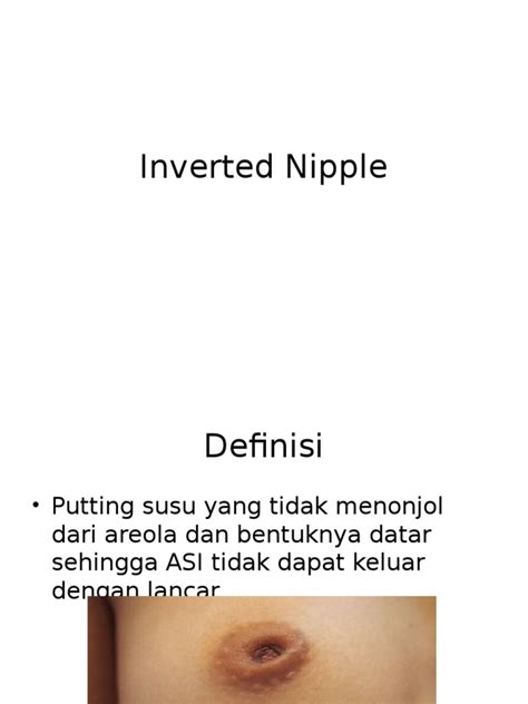 Inverted Nipple Pdf