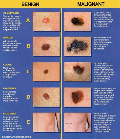 Abcde Skin Cancer Chart