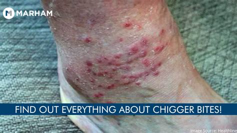 Chigger Bite Pictures Symptoms Prevention And Treatment Marham