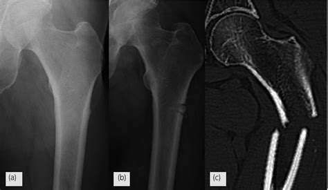 Case Of Atypical Femoral Fractures That Mimicked The Typical Imaging