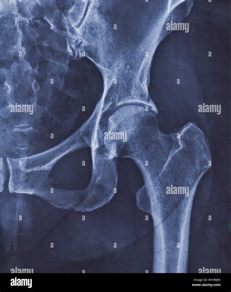X Ray Image Of Hip Joint With Signs Of Coxarthrosis Stock Photo Alamy
