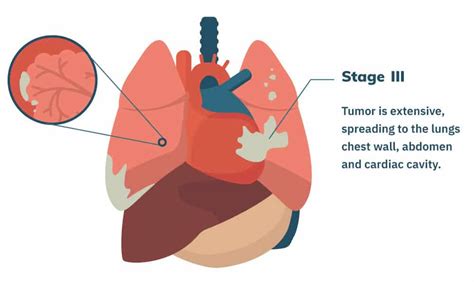 Stage 3 Mesothelioma Treatment Options And Prognosis