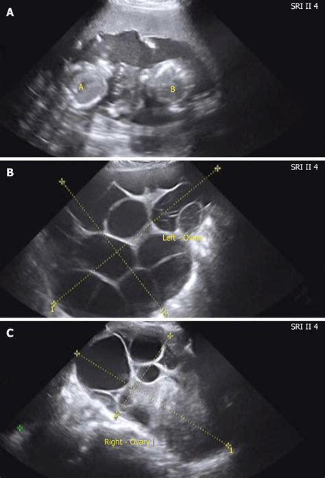 Spontaneous Ovarian Hyperstimulation Syndrome Report Of Two Cases