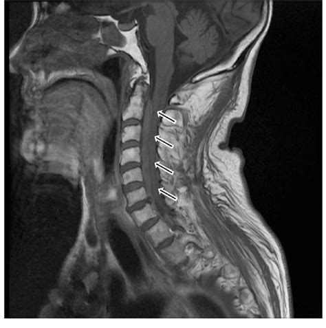A Sagittal T1 Weighted Magnetic Resonance Image Of The Spine Showing An