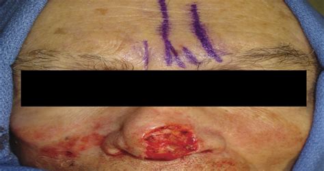 Paramedian Forehead Flap Advances Procedural Nuances And