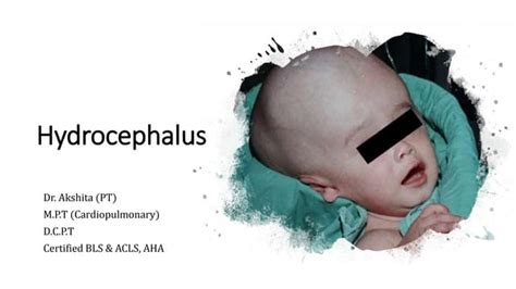 Top 5 Symptoms And Causes Of Hydrocephalus