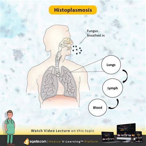 Histoplasmosis Medical Mnemonics Lecture Medicine