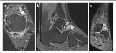 The most common ossicle is the os trigonum, which is a prominent unfused apophysis of the lateral tubercle of the talus. Figure 5 from The frondiform ligament and ...
