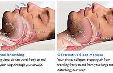 apnea osa breathing obstructive oxygen disorders cpap faqs lack