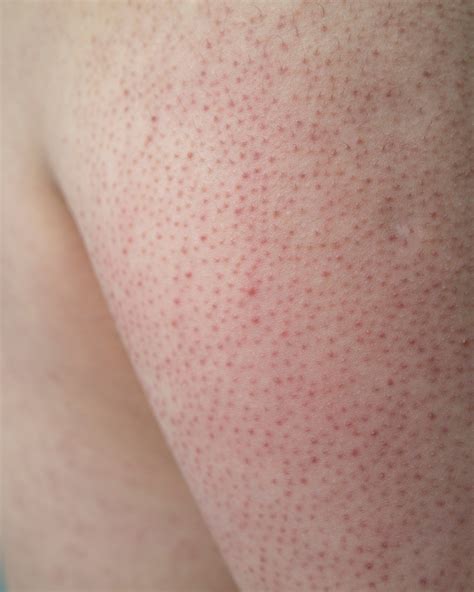 Will Keratosis Pilaris Go Away The Causes And Treatments For Keratosis