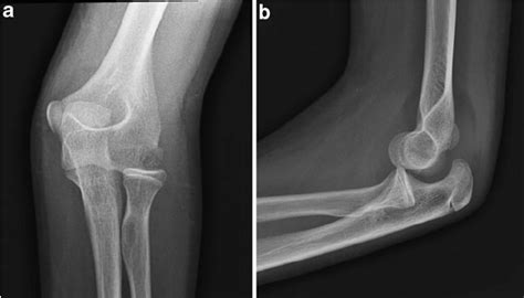 The Ap A And Lateral View B Of The Elbow Showing The Avulsion