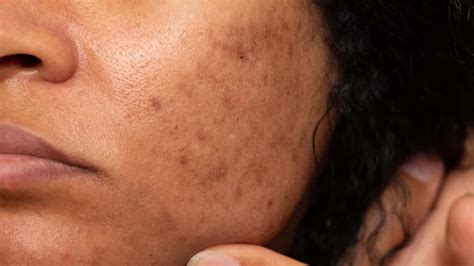 Which Vitamin Deficiency Causes Pigmentation On Face