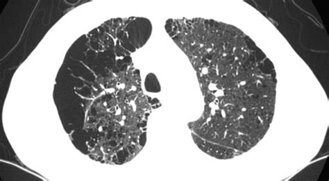 Low Dose Ct Screening For Lung Cancer Now Covered By
