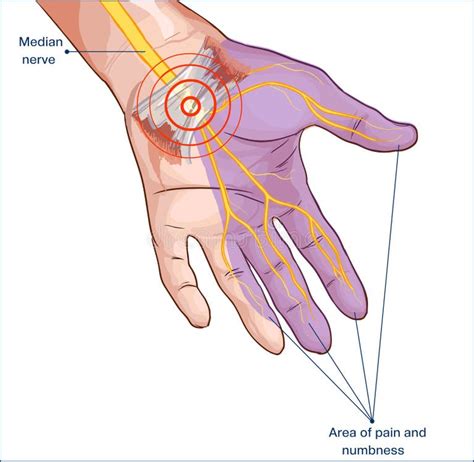Carpal Tunnel Surgery Stock Illustrations 106 Carpal Tunnel Surgery