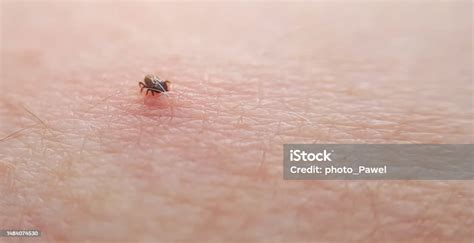 Tick Macro Photo On Human Skin Ixodes Ricinus Bloated Parasite Bitten