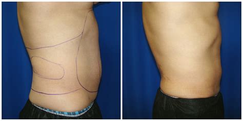 Patient 261 Female Liposuction Before And After Photos Katy Plastic