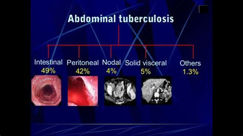 Abdominal Tuberculosisgastrointestinal Tuberclulosisperitoneal
