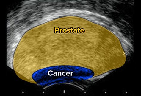 Prostate Cancer Diagnosis And Staging