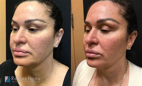 Kybella For Jowls Injections Before And After Photos New Jersey