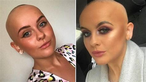 Woman With Alopecia Shares Inspirational Message To Encourage Others To