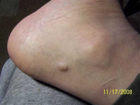 Lump On Ball Of Foot