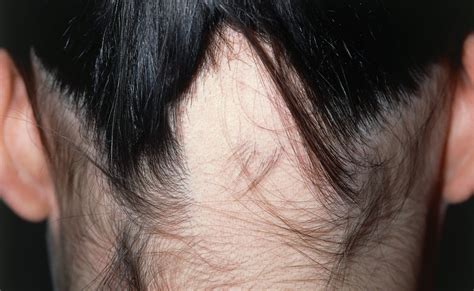 Alopecia Areata Clinical Characteristics Of Those With And Without