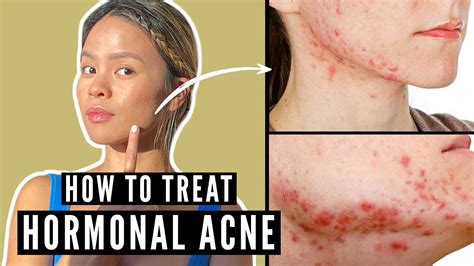 Hormonal Acne Treatment Say Hello And Goodbye To Them Youtube