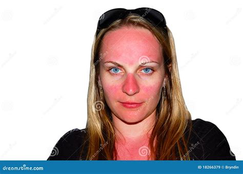 Sunburns On A Girls Face Stock Image Image Of Burn 18266379